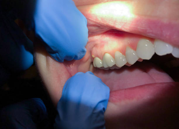 Best Emergency Care for Gum Disease in Silver Lake, FL